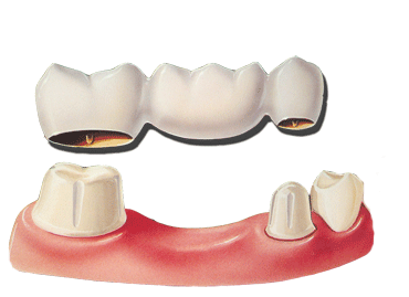 Teeth Replacement with Crowns and Bridges in Hyderabad