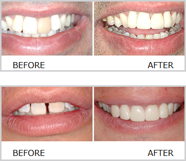 Zirconia Crowns and Bridges in Hyderabad