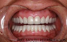 Full mouth rehabilitation