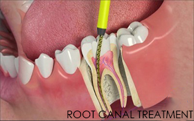 Root canal treatment