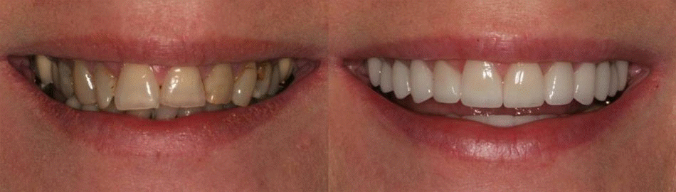 Best Dentist in Hyderabad-Full Mouth Rehabilitation